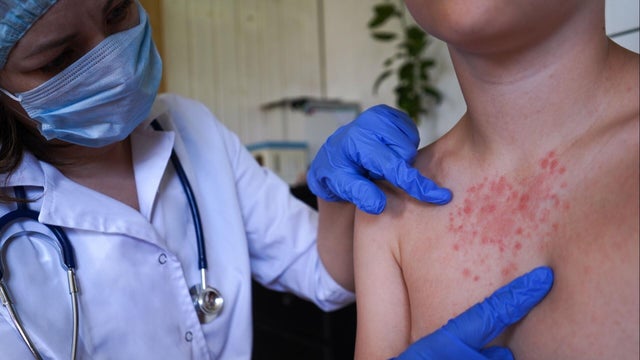cbsn-fusion-the-measles-most-contagious-virus-known-humankind-doctor-says-thumbnail.jpg 